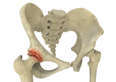 Osteoarthritis of the Hip 